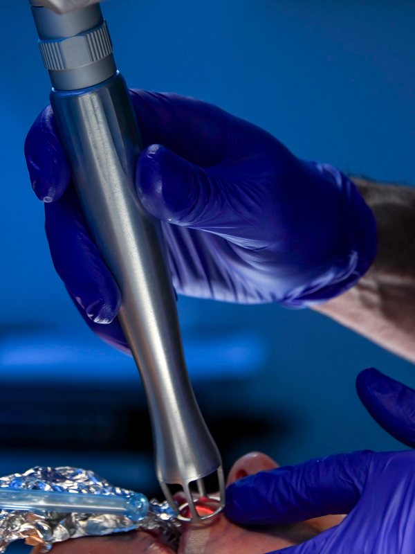 Gloved hands guiding a fractional laser handpiece